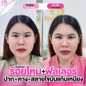 สินค้า ประกาศ อุดร-ฉีดโบท็อก ยกกระชับ เสริมความงามอุด ลดริ้วรอย ฉีดฟิลเลอร์อุดรธานี